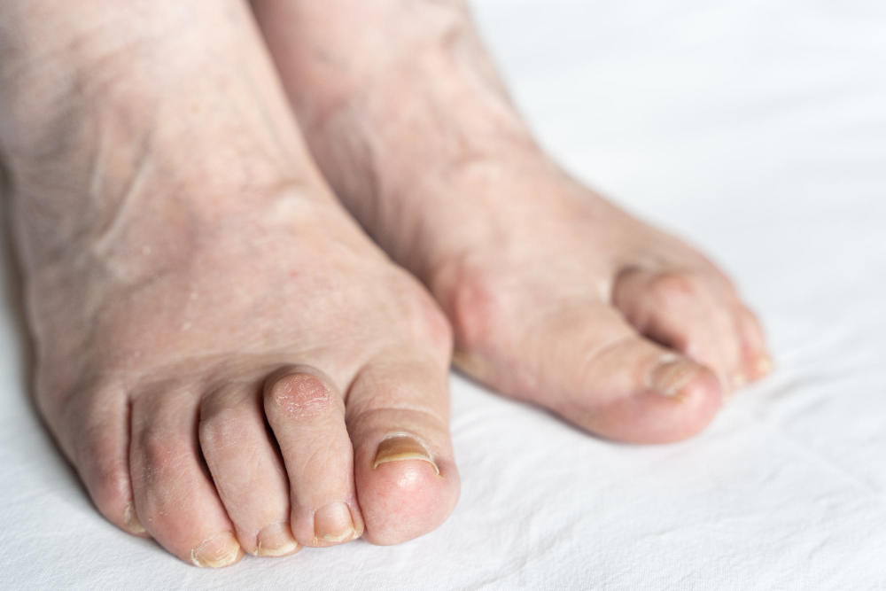 Bunions  Scottsdale, AZ 