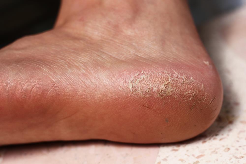 Calluses  Scottsdale, AZ 