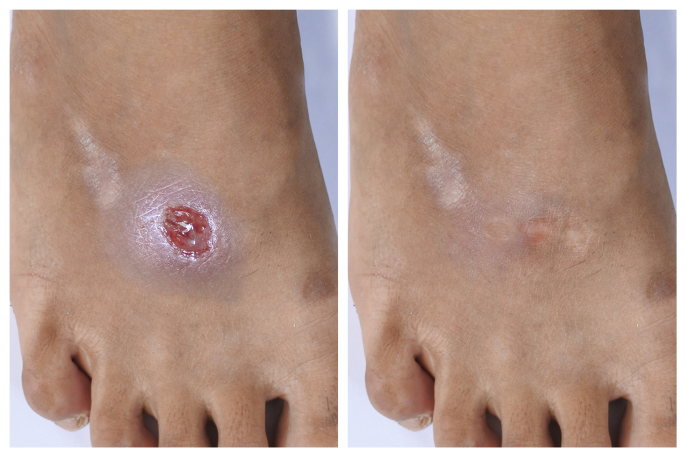 Wound Care  Scottsdale, AZ 